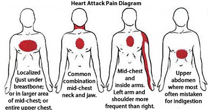 Does the Arm Pain Signal a Heart Attack? 8 Facts You Need ...