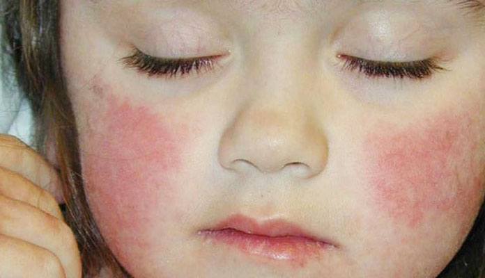 Dengue Fever Symptoms Causes And Treatments New Life Ticket Part 4