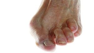 Burning Feet – Symptoms, Causes & Treatments | New Life Ticket - Part 4