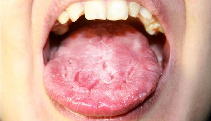 Sore Tongue Causes Symptoms And Treatments New Life Ticket