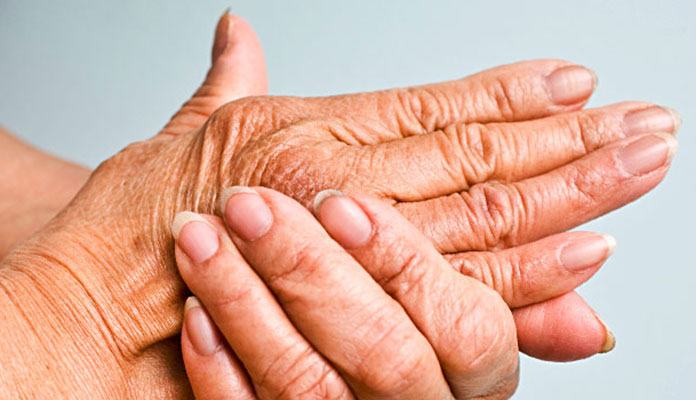 Testimonios de personas con artritis psoriásica