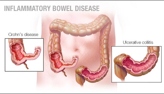 Colon Cancer Symptoms And Causes New Life Ticket Part 9