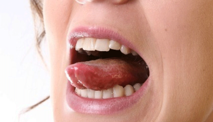 Cancer Bumps On Tongue