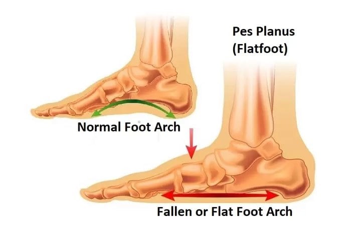Flatfoot (Pes Planus) – Facts to Know | New Life Ticket